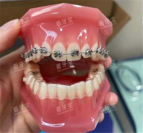 金属托槽矫正牙模.jpg 金属托槽矫正牙模.jpg