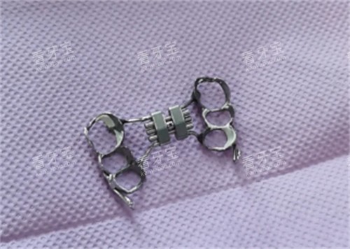粘接式扩弓器的样子.jpg 粘接式扩弓器的样子.jpg