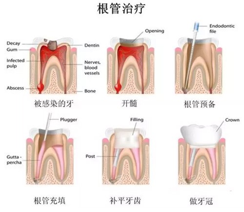 牙齿根管治疗过程图.jpg 牙齿根管治疗过程图.jpg