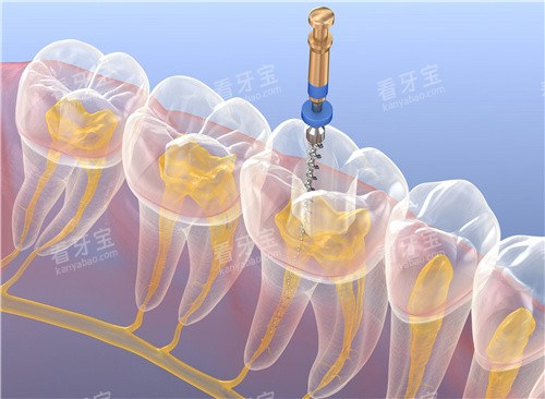 根管治疗透视图.jpg 根管治疗透视图.jpg