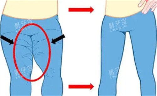 大腿吸脂对比.jpg 大腿吸脂对比.jpg