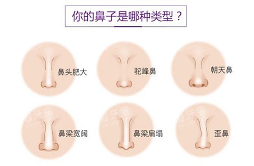 需要隆鼻常见鼻型.jpg 需要隆鼻常见鼻型.jpg