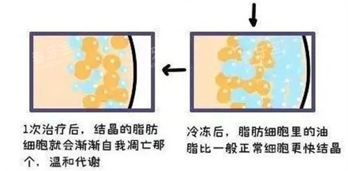 酷塑吸脂原理.jpg 酷塑吸脂原理.jpg
