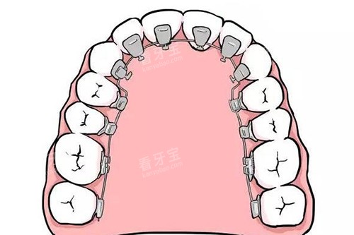 舌侧矫正器卡通示意图.jpg 舌侧矫正器卡通示意图.jpg