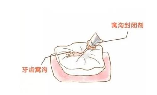 窝沟封闭示意图.png 窝沟封闭示意图.png