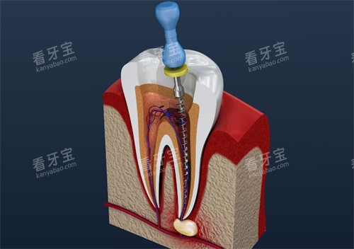 根管治疗中的牙齿.jpg 根管治疗中的牙齿.jpg