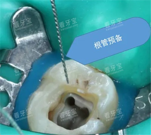 根管治疗治疗图.jpg 根管治疗治疗图.jpg