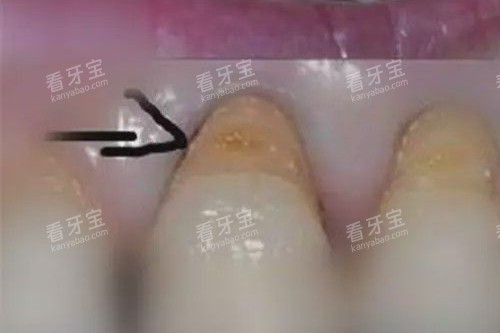 牙齿楔状缺损照片.jpg 牙齿楔状缺损照片.jpg