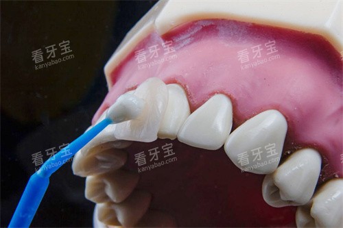 粘贴贴面.jpg 粘贴贴面.jpg