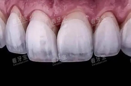 超薄牙贴面照片图.jpg 超薄牙贴面照片图.jpg