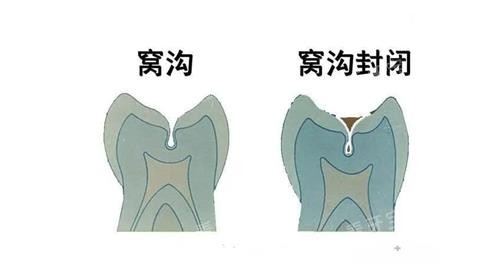 窝沟封闭前后的对比图.png 窝沟封闭前后的对比图.png