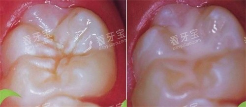 窝沟封闭前后.jpg 窝沟封闭前后.jpg