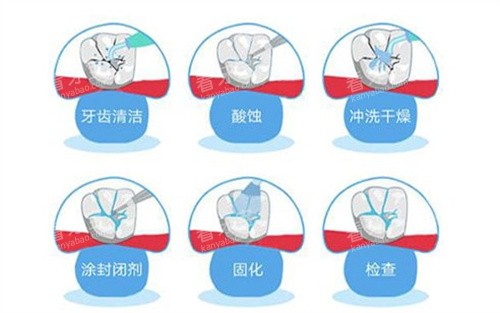 窝沟封闭的过程.jpg 窝沟封闭的过程.jpg