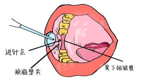 牙周内注射麻醉.jpg 牙周内注射麻醉.jpg