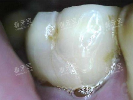 牙周炎症照片.jpg 牙周炎症照片.jpg