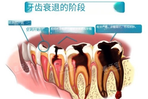 牙齿衰退阶段图 牙齿衰退阶段图