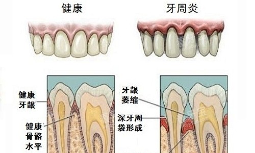 牙周炎情况展示.jpg 牙周炎情况展示.jpg