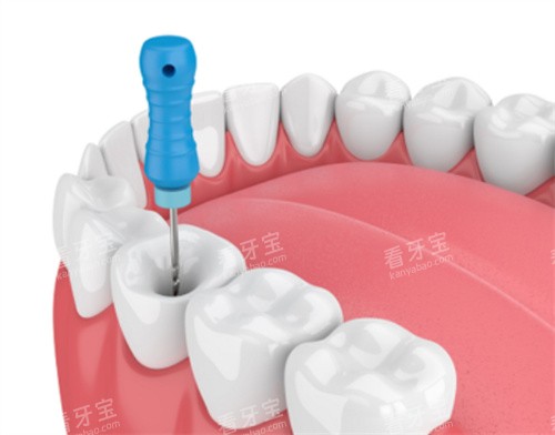 根管治疗模型.jpg 根管治疗模型.jpg