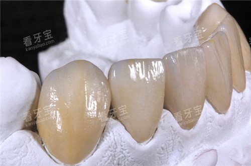 vita全瓷牙成品.jpg vita全瓷牙成品.jpg