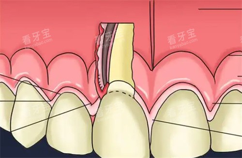 牙周病.jpg 牙周病.jpg