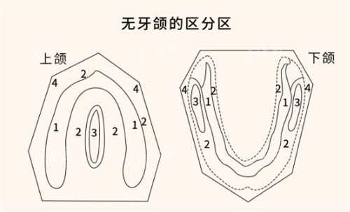 无牙颌分区图.jpg 无牙颌分区图.jpg