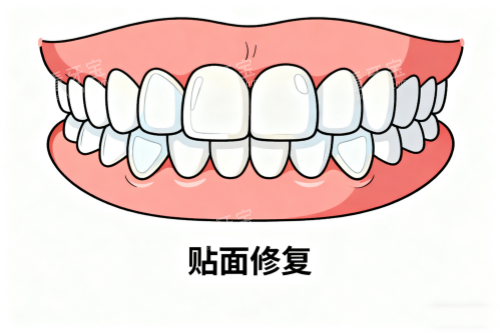 牙齿贴面修复卡通图.png 牙齿贴面修复卡通图.png