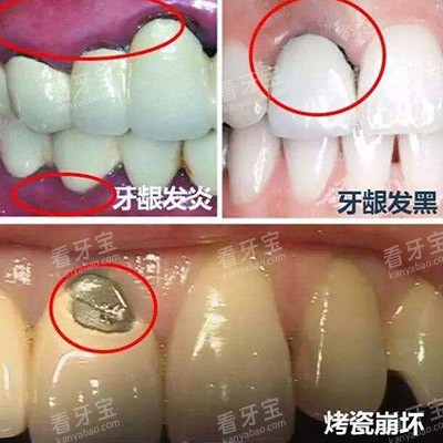 烤瓷牙冠修复缺点.jpg 烤瓷牙冠修复缺点.jpg