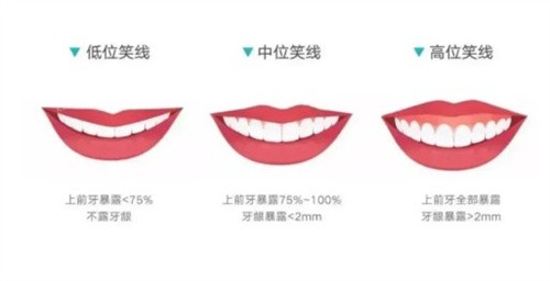 微笑线是什么?.jpg 微笑线是什么?.jpg