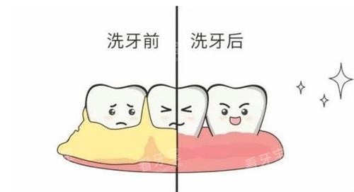 洗牙前后的对比.png 洗牙前后的对比.png