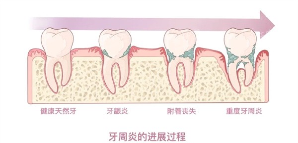 牙周炎.jpg 牙周炎.jpg