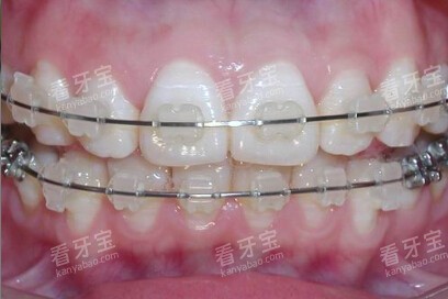 陶瓷半隐形牙套.jpg 陶瓷半隐形牙套.jpg