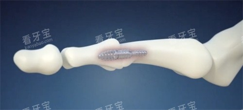 脚趾矫正手术内部固定.jpg 脚趾矫正手术内部固定.jpg