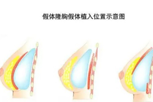 假体隆胸示意图.jpg 假体隆胸示意图.jpg