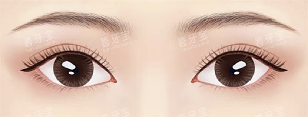 上眼睑松弛矫正.jpg 上眼睑松弛矫正.jpg