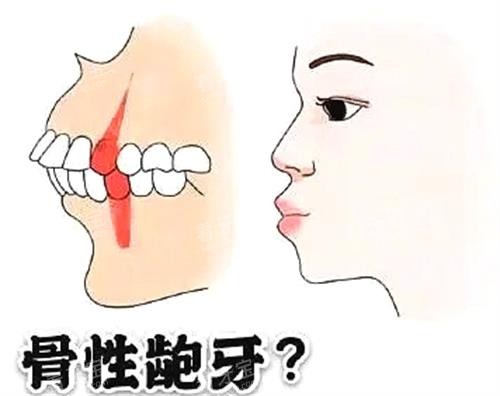 骨性龅牙和齿性龅牙.jpg 骨性龅牙和齿性龅牙.jpg