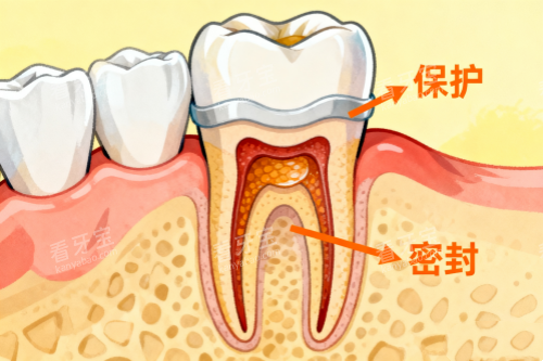 根管治疗卡通展示图.png 根管治疗卡通展示图.png