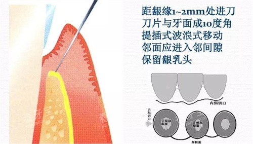 牙周炎翻瓣手术全切口.jpg 牙周炎翻瓣手术全切口.jpg