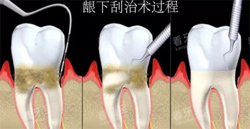龈下刮治过程.jpg 龈下刮治过程.jpg