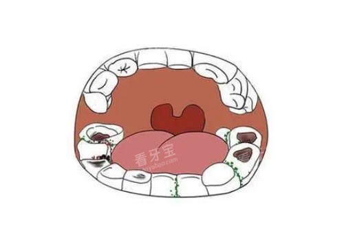 牙齿蛀牙问题卡通图.jpg 牙齿蛀牙问题卡通图.jpg
