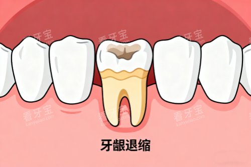 牙龈萎缩展示图.png 牙龈萎缩展示图.png