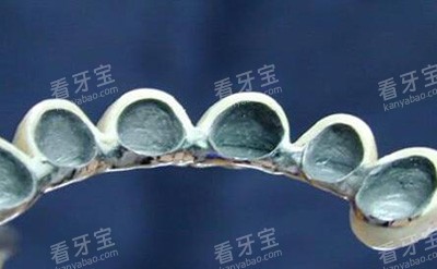 传统烤瓷牙冠材料.jpg 传统烤瓷牙冠材料.jpg
