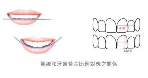 正畸微笑线.jpg 正畸微笑线.jpg