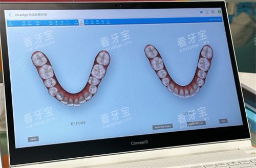北京亿阳口腔牙齿模拟图.jpg 北京亿阳口腔牙齿模拟图.jpg