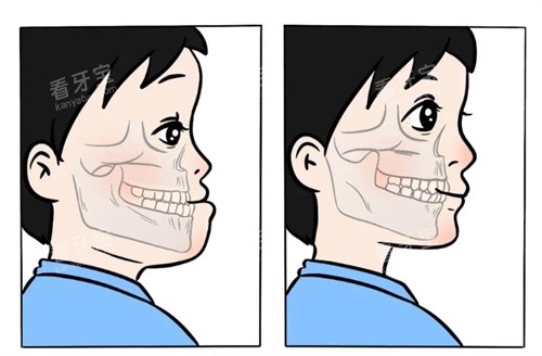 地包天矫正前后对比图.jpg 地包天矫正前后对比图.jpg