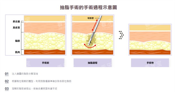 吸脂手术过程示意.jpg 吸脂手术过程示意.jpg