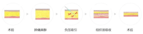 吸脂过程图解.jpg 吸脂过程图解.jpg