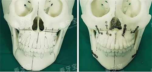 正颌手术手术原理展示图.jpg 正颌手术手术原理展示图.jpg