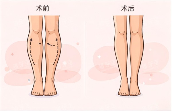 小腿吸脂手术前后对比.jpg 小腿吸脂手术前后对比.jpg
