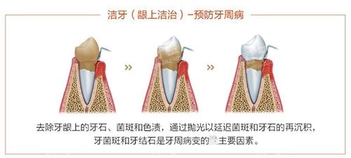 洗牙龈上洁治过程示意图.jpg 洗牙龈上洁治过程示意图.jpg
