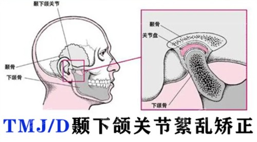 颞下颌关节紊乱矫正.jpg 颞下颌关节紊乱矫正.jpg